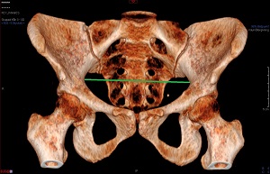 Diameter transversa