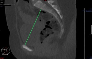 Sagittal ingångsdiameter